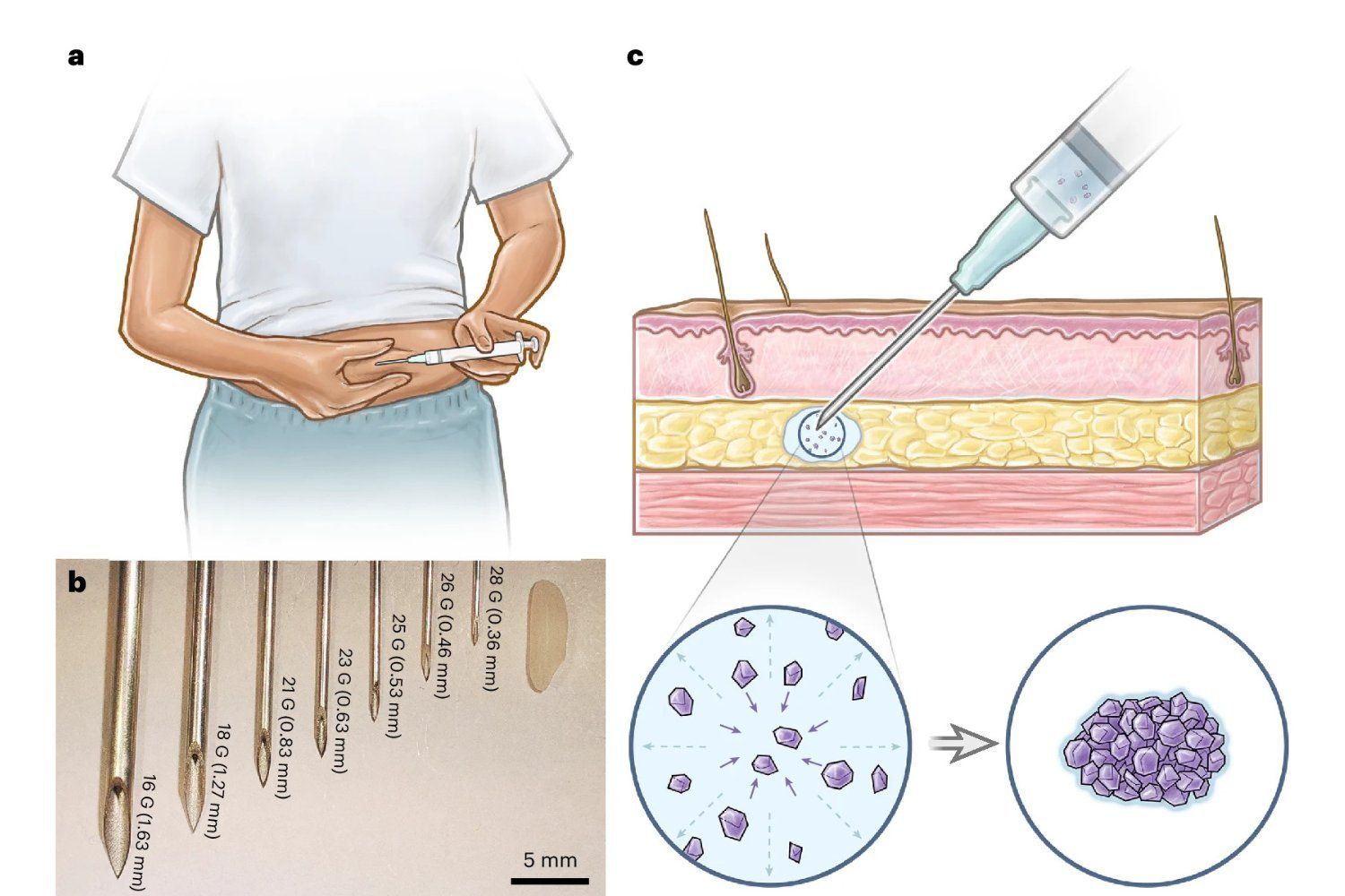 Implante Contraceptivo