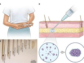thumbnail - Implante Contraceptivo