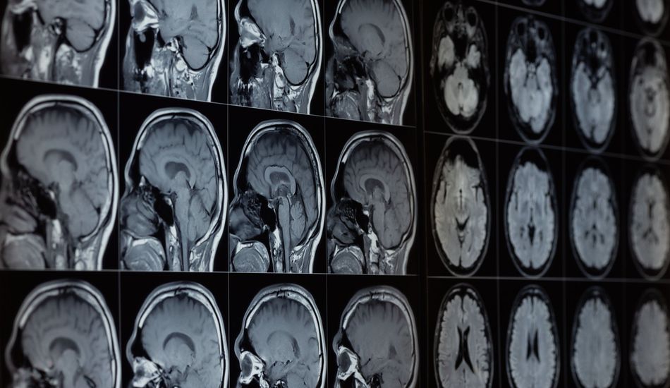 Doença de Alzheimer